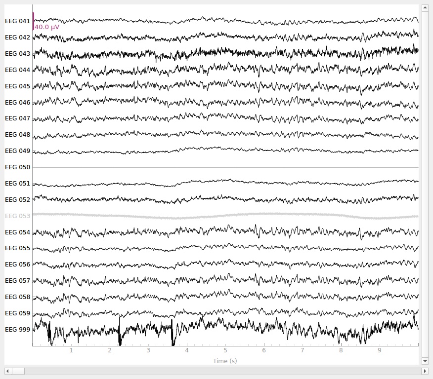 Jól megválasztott referencia ponthoz viszonyítva értékes jeleket olvashatuk ki sokcsatornás EEGvel.