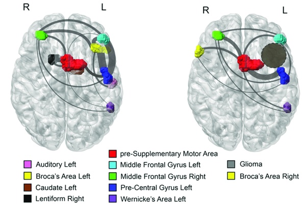 Kölcsönható agyi területek nyelvi feladat megoldása közben egészséges (bal) és agydaganatos emberben (jobb).