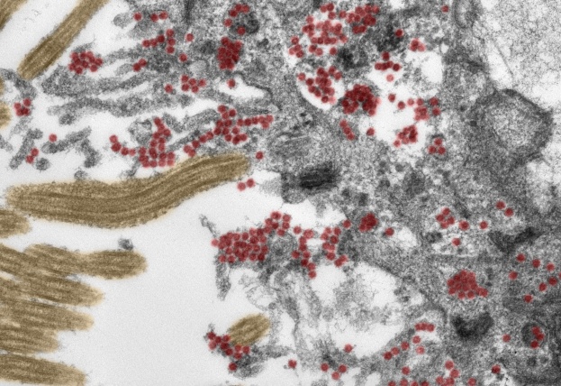 Az agyat megfertőző koronavírus részecskék elektronmikroszkópos képe