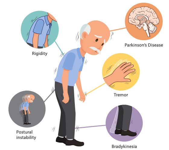 Parkinson kórban a dopaminerg rendszer pusztulása a striátimból induló GO és NoGO pályák közötti egyensúly felbomlása miatt a mozgás részleges vagy teljes gátlását eredményezi.