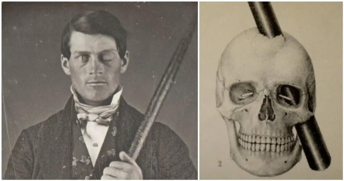 Phineas Gage és híres vasrúdja, valamint annak rekonstrukciója, hogy milyen agyterületeket semmisített meg. A bal prefrontális kéreg pusztulása személyiségének megváltozásához vezetett.