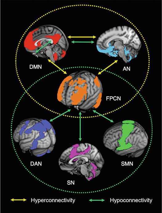 Az agy funkcionális hálózatai által szinkronba hozott területek és az egymást váltó állapotok kapcsolatának megváltozása figyelemhiányos/hiperaktivitás-zavarban (ADHD). A sárga kör az ADHD-ben megfigyelhető kóros kölcsönhatást jelöli az alapértelmezett mód hálózat (DMN, Én), a frontoparietális hálózat (FPN, kontroll) és az affektív hálózat (AN, érzelmek) között. A zöld kör az ADHD-hez társuló csökkent funkcionális kapcsolódást mutatja a frontoparietális hálózat (FPN), valamint a dorzális figyelmi hálózat (DAN), a ventrális figyelmi hálózat (VAN) és a szomatoszenzoros hálózat (SSN) között. A sárga nyilak erősödő, a zöld nyilak gyengülő kölcsönhatásokat jelölnek. A mintázatok átfedése arra utal, hogy a frontoparietális kontroll hálózat (FPN) az ADHD patofiziológiájának egyik érintett hálózata.