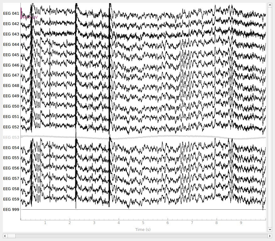 Ugyanaz az elvezetés mint az előbb, de ha rosszul választunk referencia elektródát, akkor az öszes csatornán megjelenik ugyanaz a jel és nem sok mindent értünk meg.