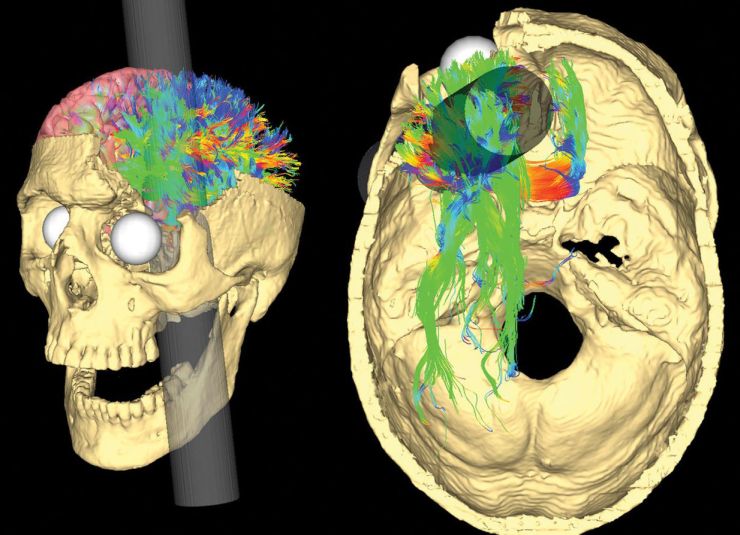 A pHineas Gage koponyáját átütő vasrúd nyomvonalának és az általa okozott agyterület és pálya károsodások modern számítógépes rekonstrukciója. A rúd a bal homloklebenyt pusztította el és ezáltal Phileas Gage személyisége megváltozott.