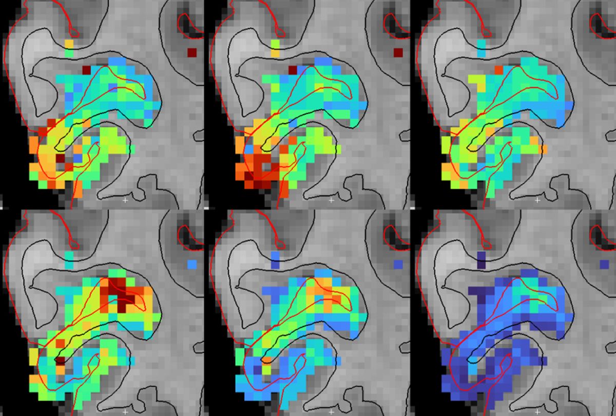 Egy modern fMRI felbontóképessége: látási feladatban képezték le egy önkéntes látókérgét, 100msec-undumonként és 500 mikromáteres felbontással.