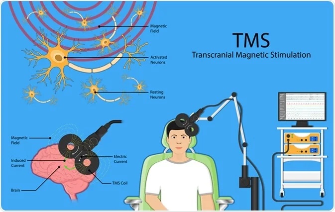 A Transcranial Magnetic Stimulation módszer esetében a koponya felszínén létrehozott gyorsan változó mágneses tér áramot indukál az idegsejtekben, és ezzel megzavarja azok működését. Megfelelő helyen elhelyezett mágnessel pontos időzítéssel kapcsolhatók ki célzott agyterületek.