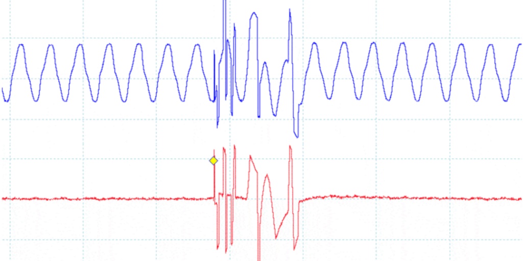 50Hz es zajjal szennyezett elektrofiziológás elvezetés (kék), rossz földelés miatt. A periódikus zajokat sáváteresztő szűrővel el lehet távolítani (piros). De ez a megoldás a jelből is eltávolítja az esetleg előforduló 50Hz-es összetevőket. Szóval jobb jól földelni.