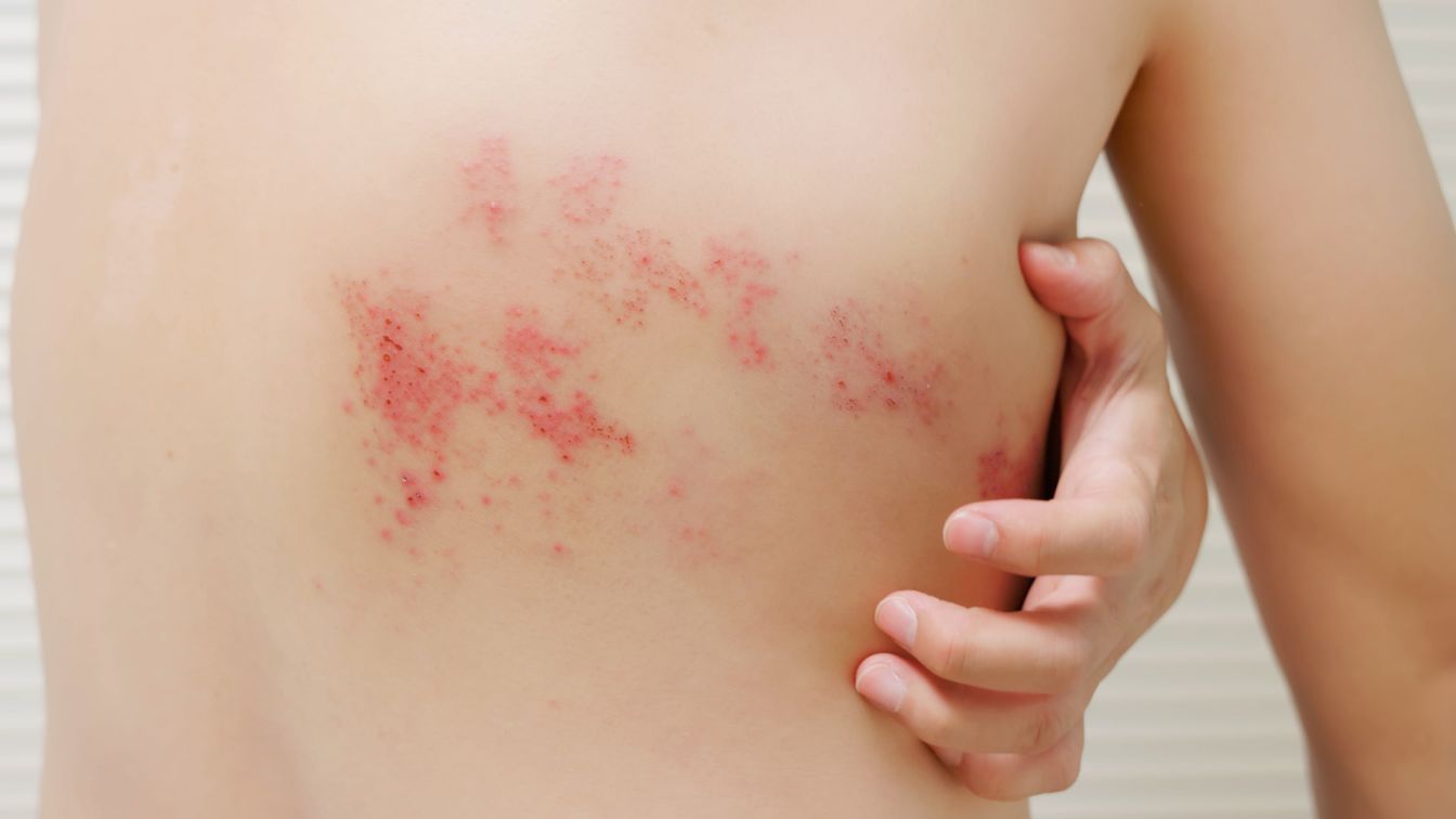 A Herpes zoster vírus által okozott övsömör egy mellkasi dermatómát rajzol ki a háton. Nekem a jobb kar, váll dermatómában volt a fertőzés.