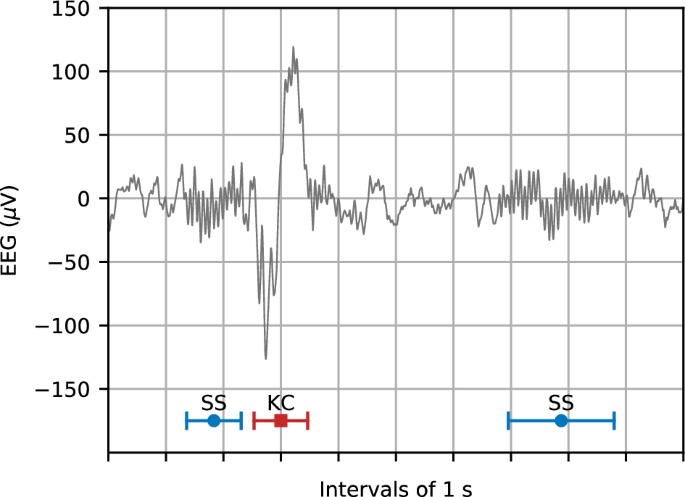 Alvás alatt megjelenő, nem periodikus K-komplexek (piros vonal) és a környezetükben rövid időre megjelenő alvási orsók (piros vonalak).