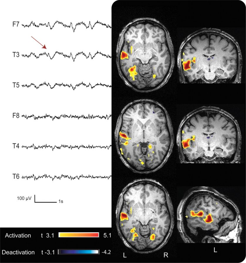 Epilepszia fókusz helyének megállapítása EEG jelek (bal oldalon) és funkcionális MRI (jobb oldal) segítségével. A sebész ezek alapján dönti el, hogy a gyógyszeresen nem kezelhető epilepszia fókuszt honnan kell eltávolítani.