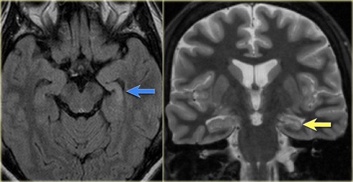Károsodott jobboldali hippokampusz MRI felvétele felül- (bal) és elől- (jobb) nézetben.