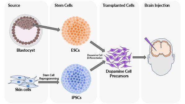 Embrionális őssejtek differenciálása dopaminerg sejekké, majd ezek  beültetése parkinson kóros agyakba ígéretes gyógyítási irány lehet.