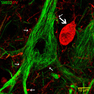 SMI32-immunfestett (zöld) humán óriás piramissejt (Betz-sejt) és egy szomszédos parvalbumin (PV)-immunopozitív (piros) interneuron (nagy nyíl) nagy nagyítású konfokális képe. A kis nyilak PV-pozitív periszomatikus terminálisokat jelölnek.