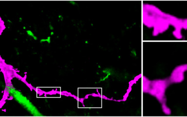 Random DiI-jelölés és immunjelölt neuronok 3D-rekonstrukciója post mortem agyakban